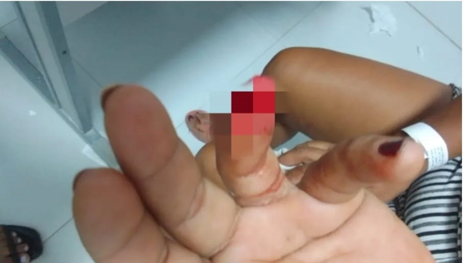 Mulher tem dedo decepado após ser mordida por um galego