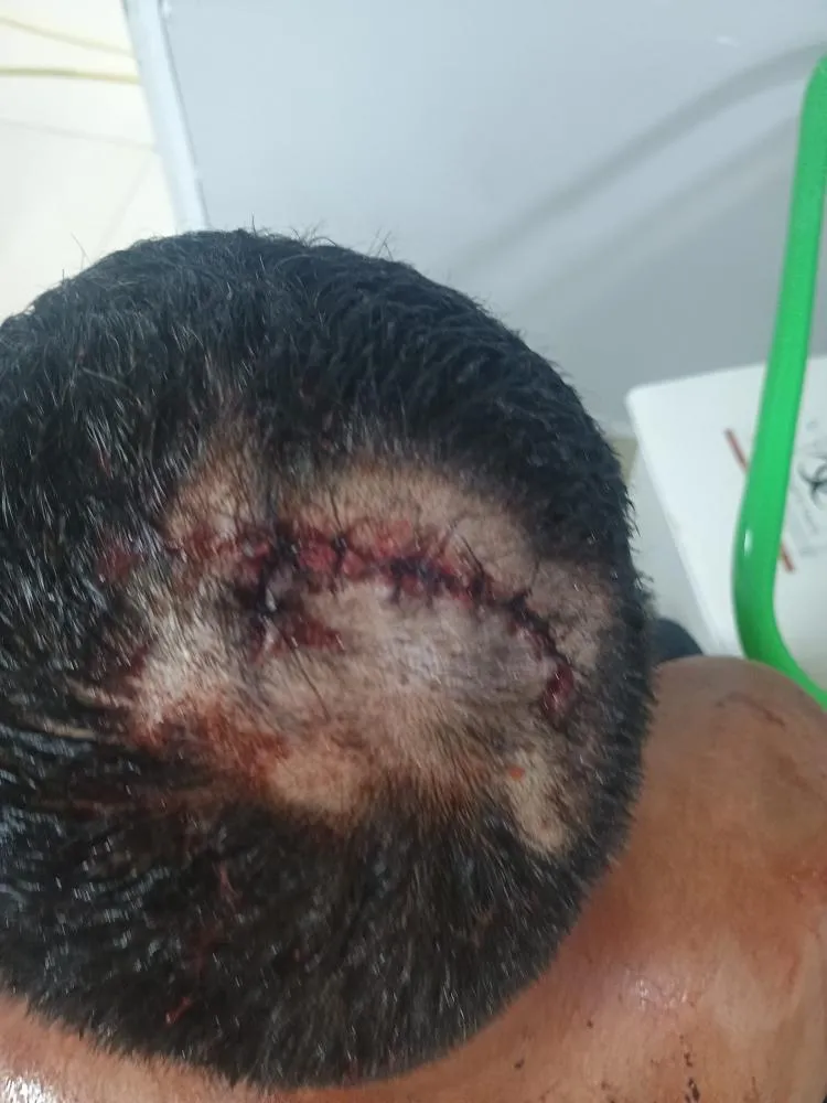 Homem é agredido na cabeça com uma alavanca
